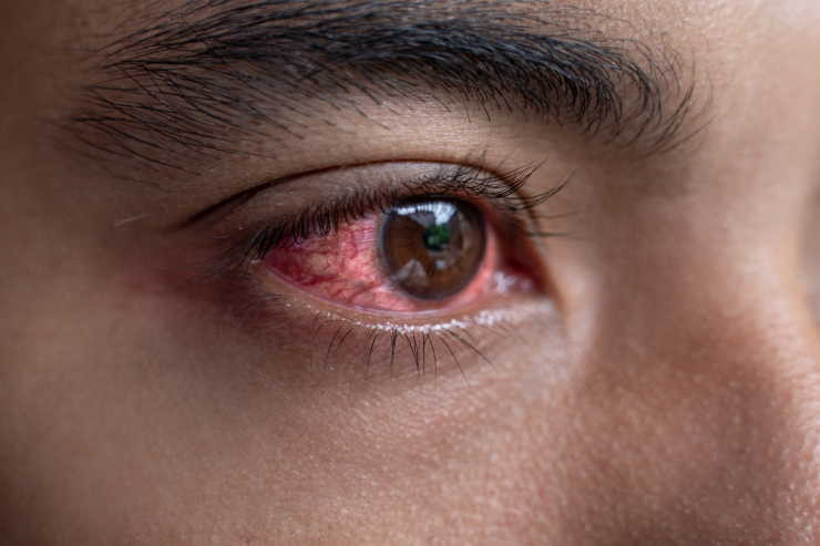 Conjunctivitis