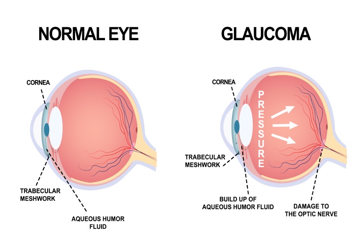 Glaucoma